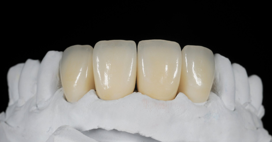 Crown and Bridges Procedure - Bilal Dental Lounge