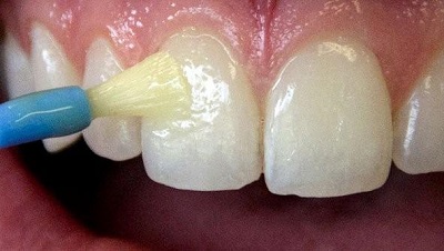 Fluoride Treatment Application - Bilal Dental Lounge