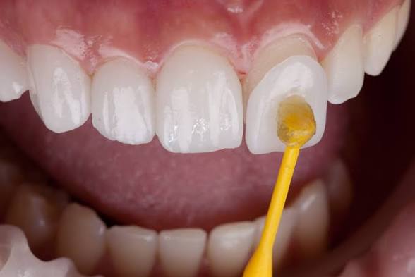 Veneers - Bilal Dental Lounge