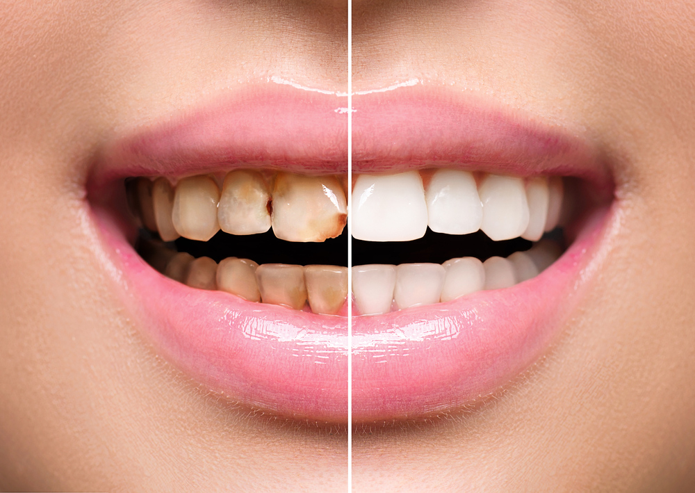 Teeth Whitening - Bilal Dental Lounge