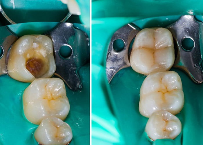 Tooth restorations - Bilal Dental Lounge